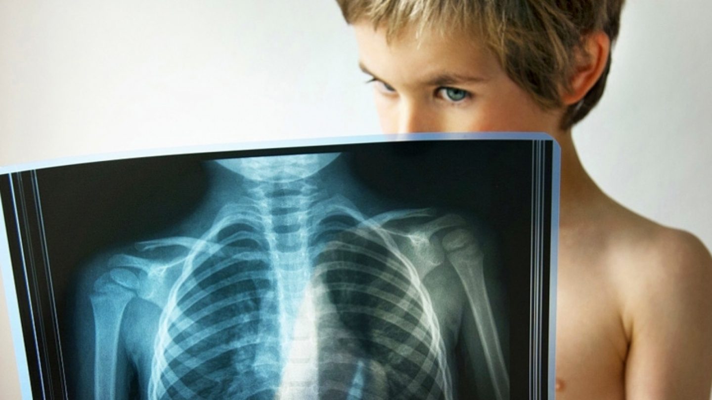 Дети болеют туберкулезом. Рентгенография у детей. Рентгенография легких у детей.