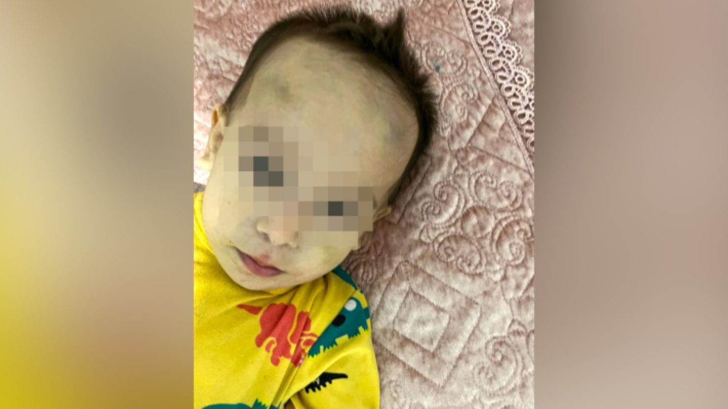 ребенок 6 месяцев упал с кровати синяк на лбу