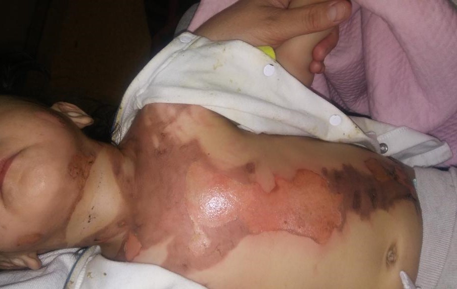 Ребёнок получил ожоги в поезде: алматинка требует от КТЖ 10 миллионов тенге